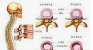 坐骨神经痛的锻炼方法