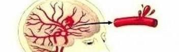 脑溢血和脑梗噻的区别是什么