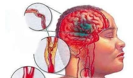 脑溢血和脑梗噻的区别是什么